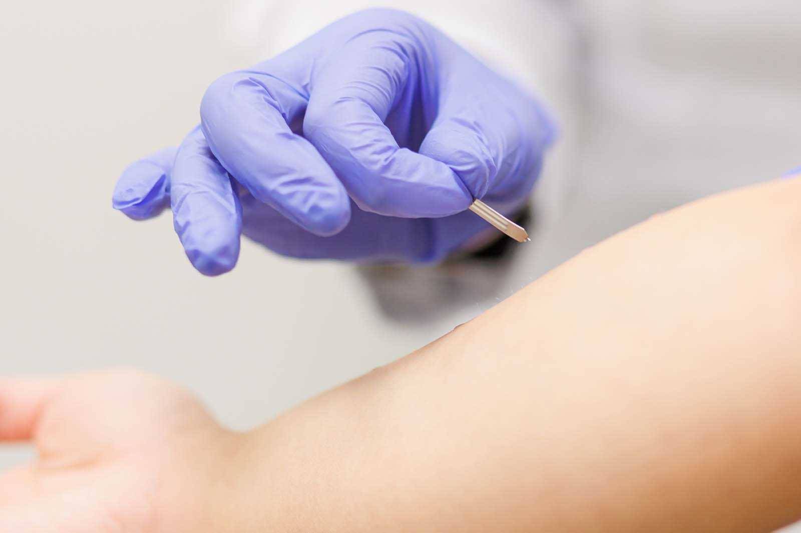 Control Skin Test Skin Prick Testing (SPT) for 510(k)